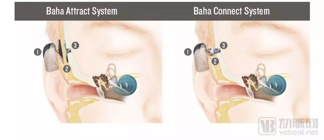 双侧耳蜗和单侧耳蜗_哪家人工耳蜗比较好咨询0爱耳时代_电子耳蜗找0爱耳时代