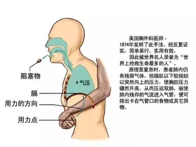 “海姆立克”法_儿童海姆立克急救法_海姆立克法